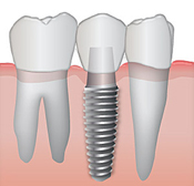 Question on bridge compared to implants