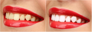 Dental Cosmetics