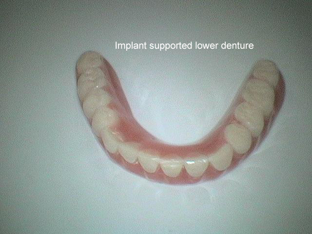 Implant supported lower denture -  A case treatment presentation