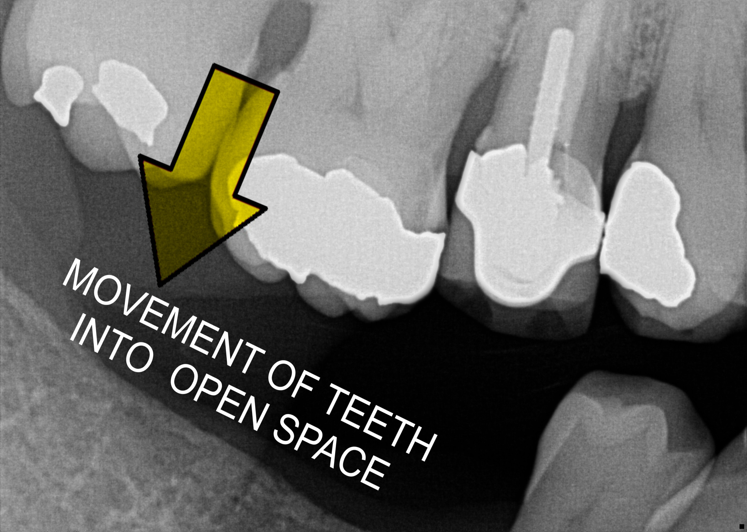 UNWANTED  tooth movement