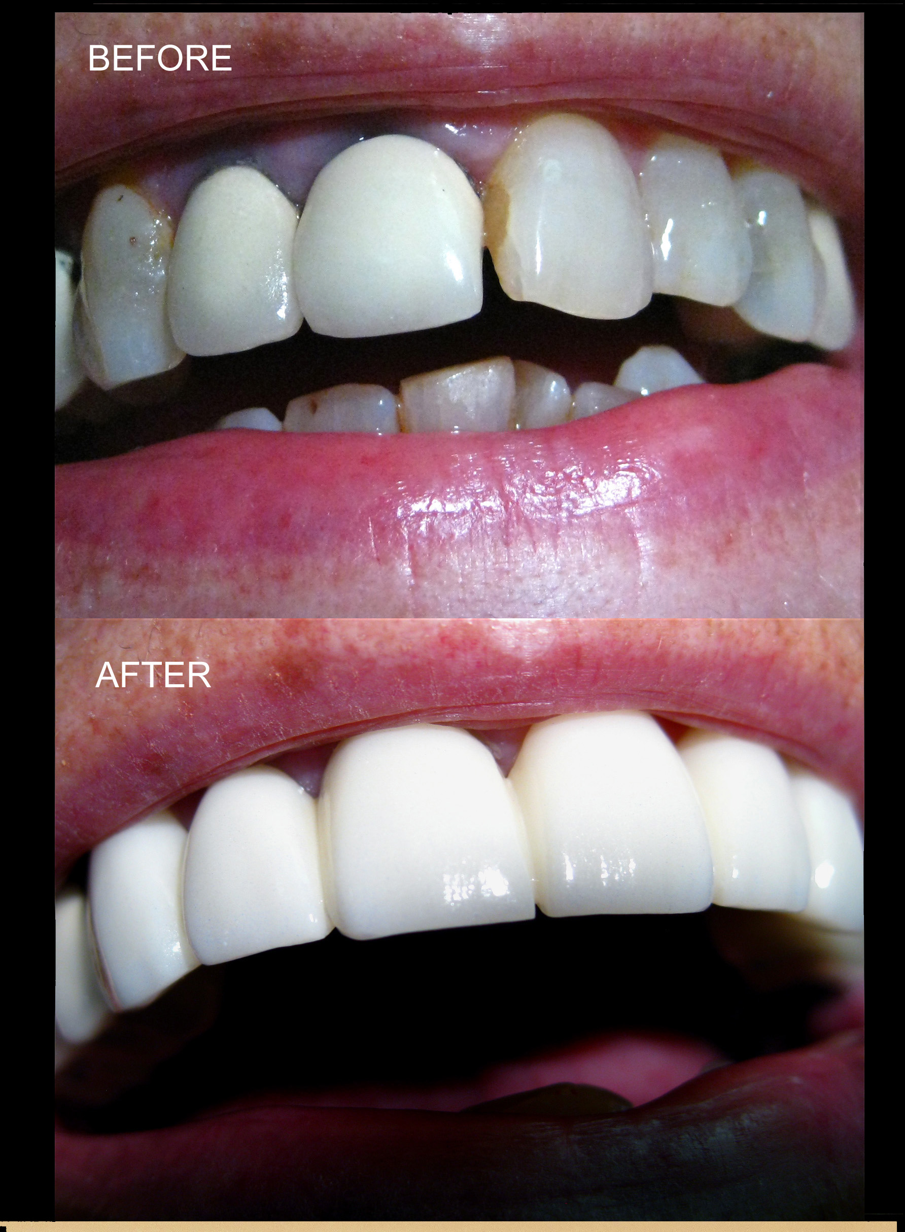 Zirconia based porcelain crowns,bridges and veneers